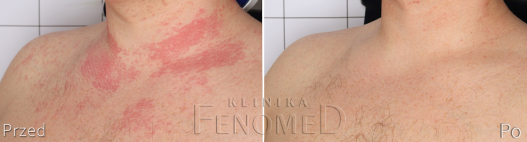 CZERWONE PLAMY NA DEKOLCIE