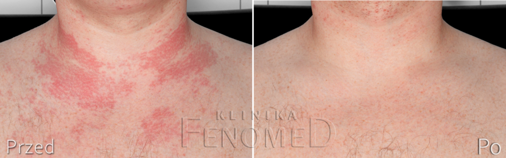 czerwone plamy na dekolcie