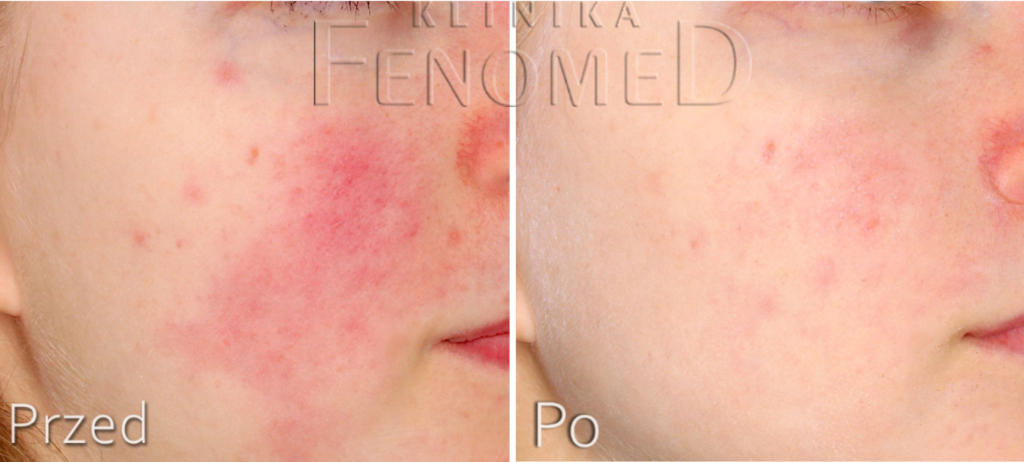 rumień usuwanie rumienia