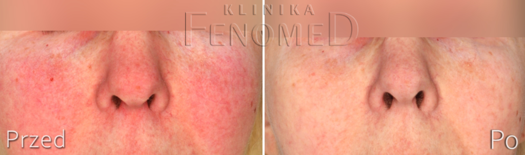 Porównanie efektów leczenia rumienia: zdjęcie twarzy przed i po zabiegach laserowych