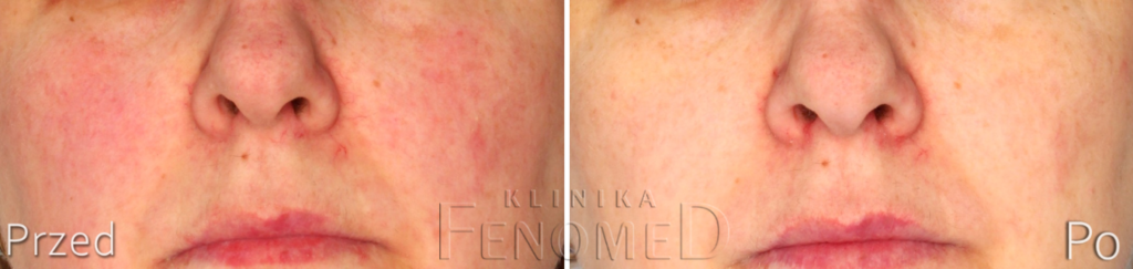 usuwanie naczynek na twarzy