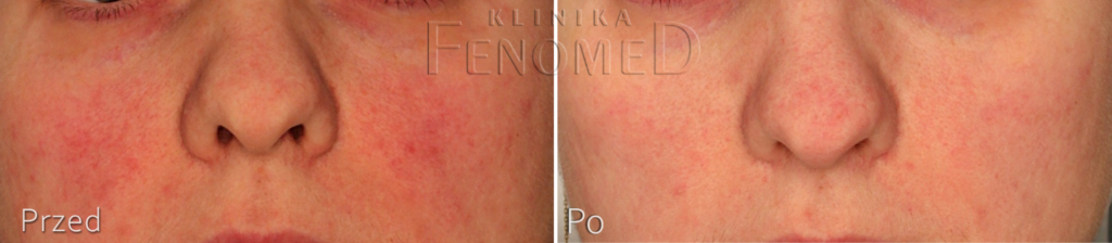 usuwanie-rumienia