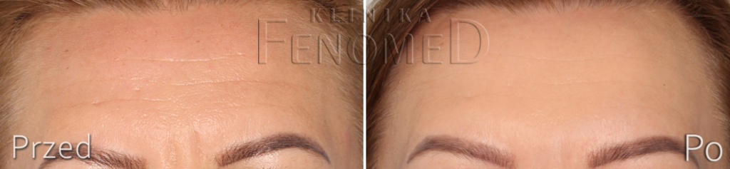 usuwanie zmarszczek czoło