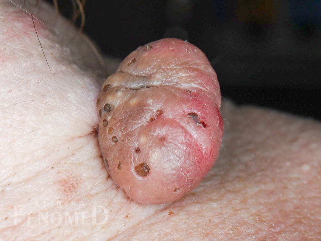 Brodawka łojotokowa - zmiana nowotworowa łagodna, kształt okrągły, wygląd grudkowaty, kolor żółty lub brunatny, brodawczak.