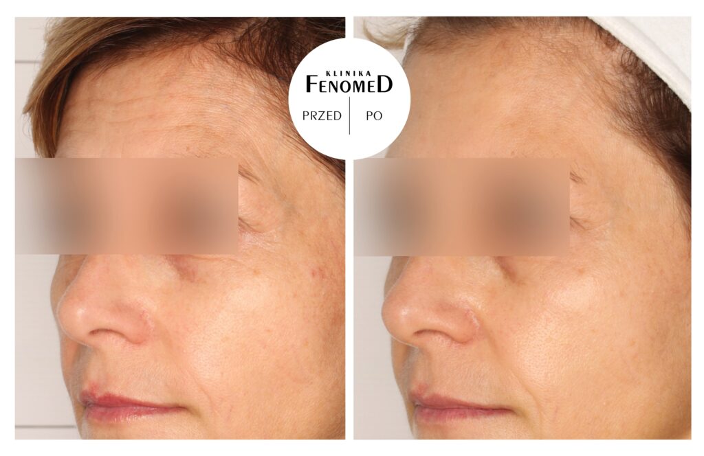 usuwanie zmarszczek na czole