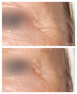 usuwanie zmarszczek wokół oczu