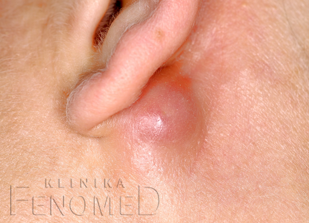 kaszak ropień usuwanie