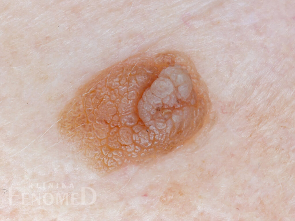 Brodawka łojotokowa - zmiana nowotworowa łagodna, kształt okrągły, wygląd grudkowaty, kolor żółty lub brunatny, brodawczak.