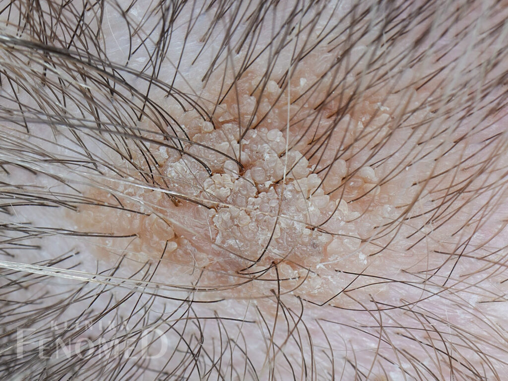 Brodawka łojotokowa - zmiana nowotworowa łagodna, kształt okrągły, wygląd grudkowaty, kolor żółty lub brunatny, brodawczak.