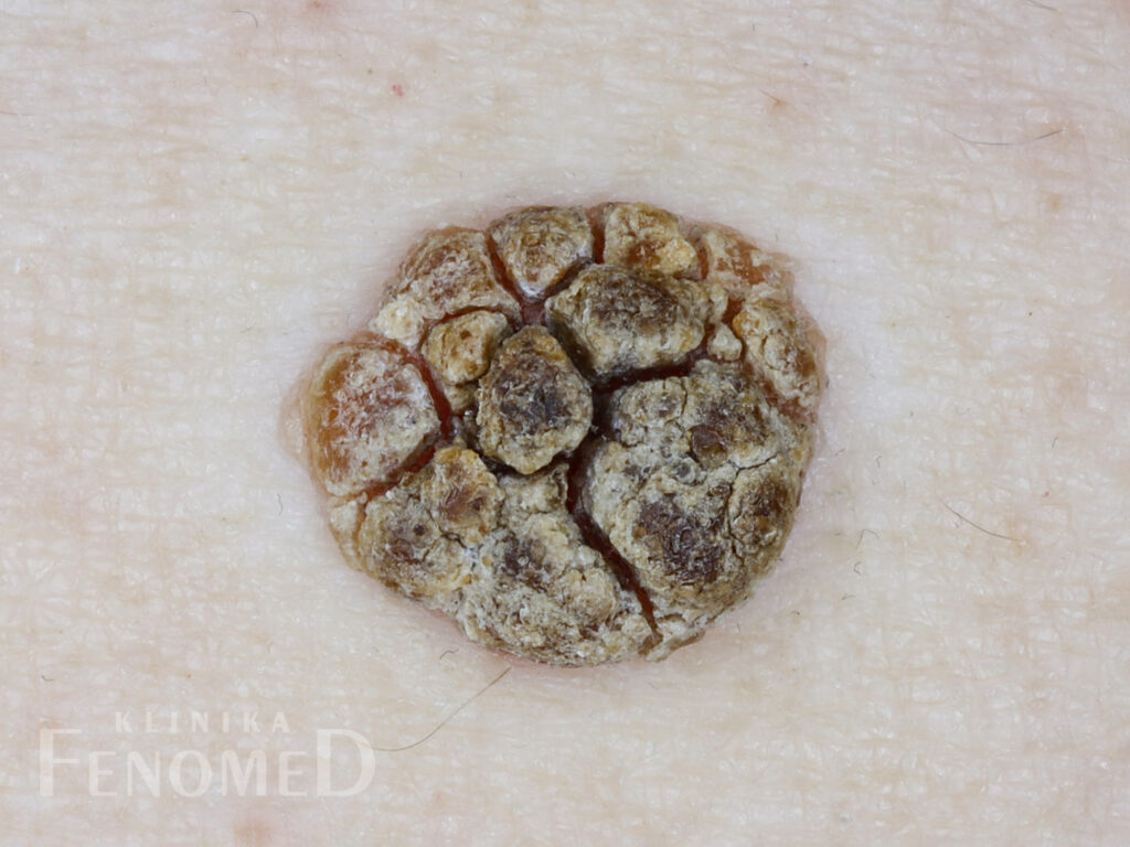 Brodawka łojotokowa - zmiana nowotworowa łagodna, kształt okrągły, wygląd grudkowaty, kolor żółty lub brunatny, brodawczak.