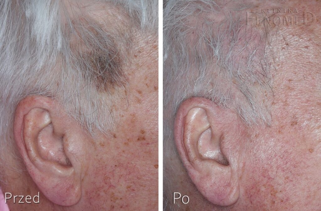 Stan przed i po usunięciu brodawki łojotokowej na skórze głowy. Zmiana nowotworowa łagodna, kształt okrągłym wygląd grudkowaty, brodawczak.