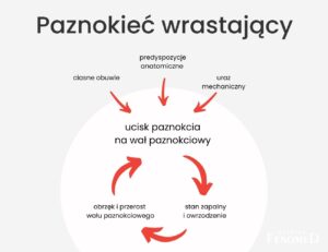 wrastający paznokieć - schemat powstawania