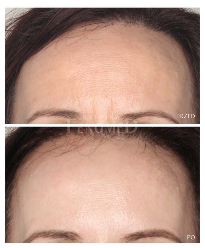 usuwanie zmarszczek na czole i między brwiami