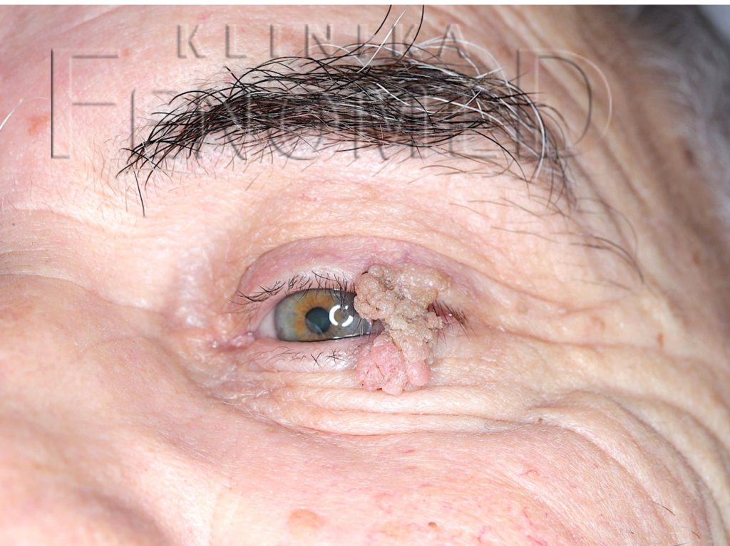 brodawka łojotokowa