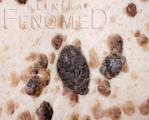 Brodawka łojotokowa (verruca seborrhoica)