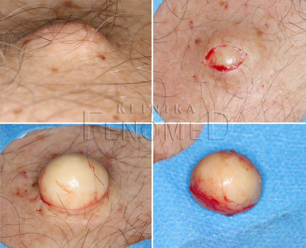 guzek na klatce piersiowej