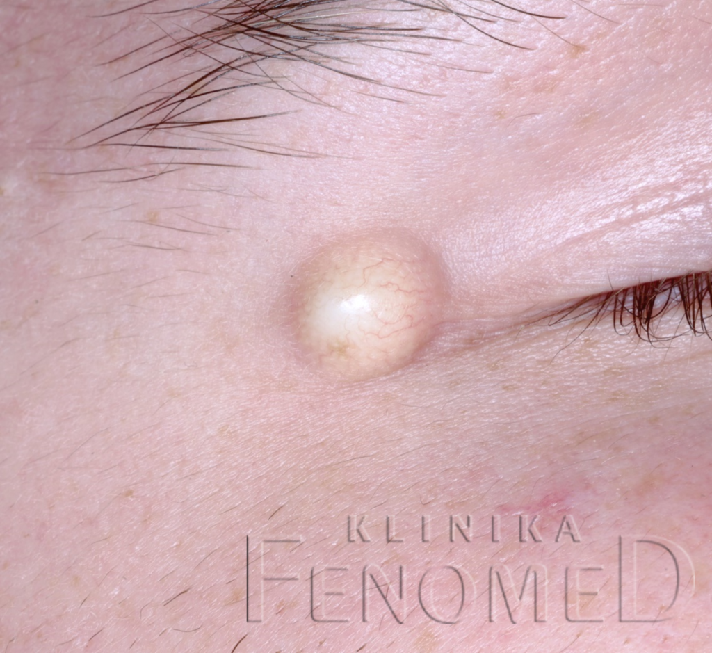 żółta twarda kulka obok oka