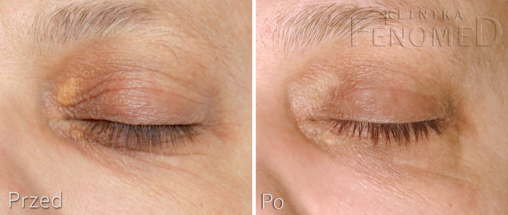 Kępki żółte powiek to zmiany skórne okolic oczu, guzki lub o kształcie płaskim, u osób ze zwiększonym stężeniem lipidów