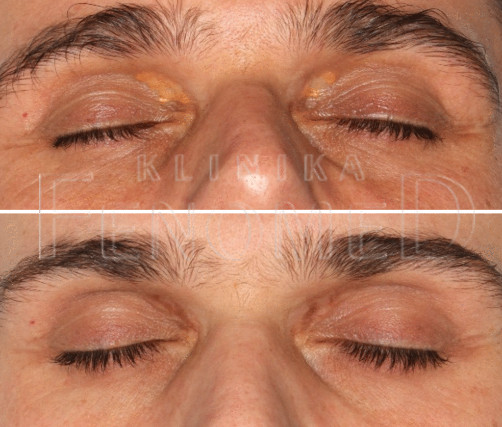 Kępki żółte powiek. Efekt przed i 3 miesiące po wycięciu.