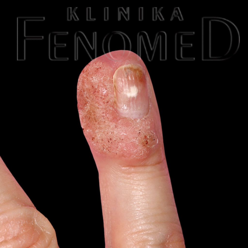 Brodawki wirusowe (Verruca vulgaris)