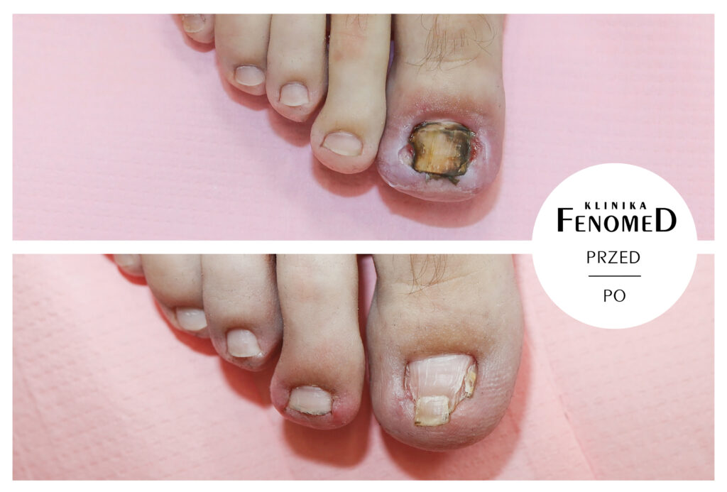 leczenie wrastającego paznokcia
