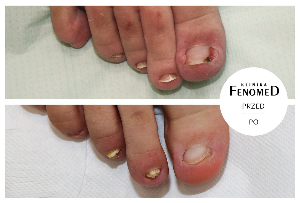 leczenie wrastającego paznokcia