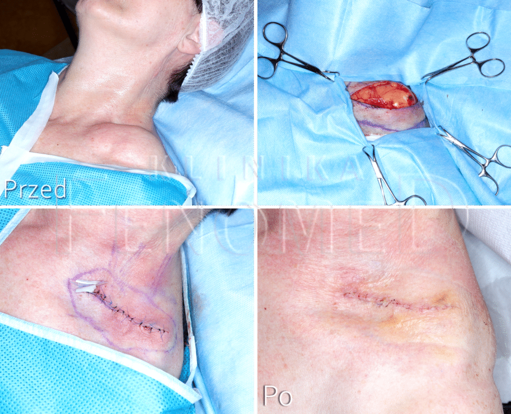 Etapy usuwania dużego tłuszczaka z okolicy obojczykowej. Efekt po 1 miesiącu od zabiegu.