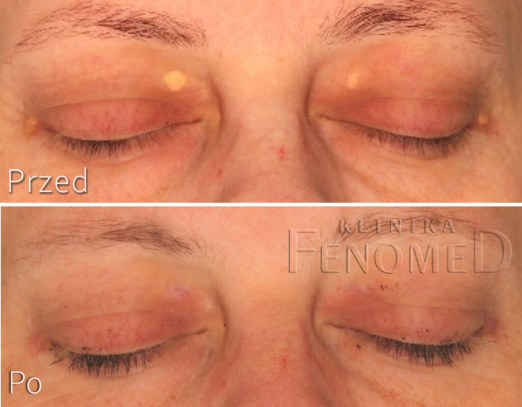 kępki żółte usuwanie