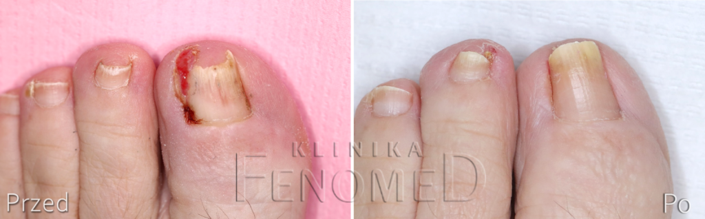 wrastajacy-paznokiec
