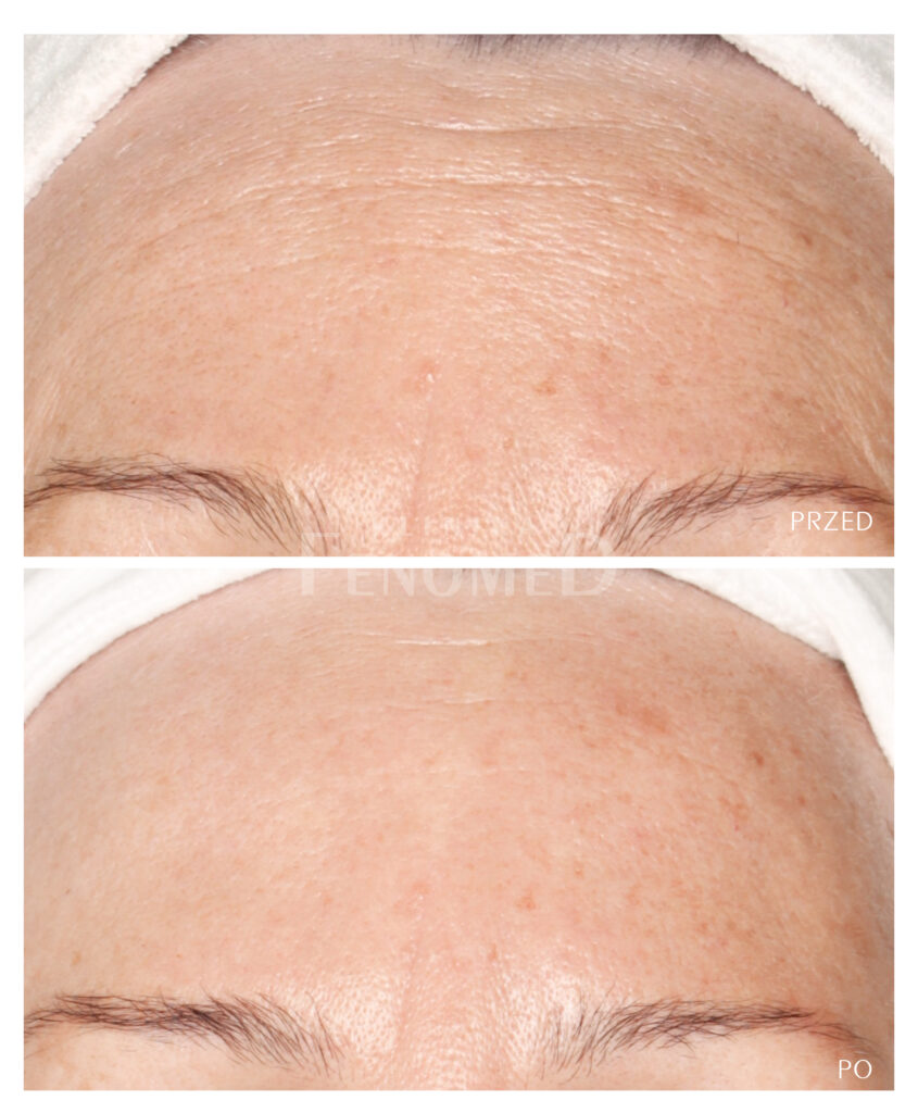 zmarszczki poziome czoła botoks