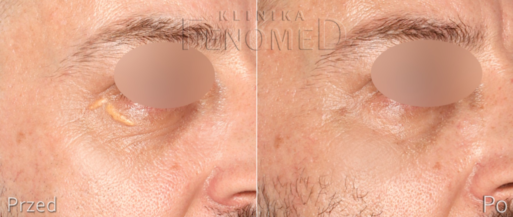 zółte plamy pod okiem