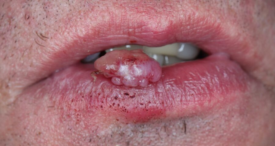 Ziarniniak naczyniowy w rzadkiej lokalizacji na czerwieni wargowej wargi dolnej u dojrzałego mężczyzny. Ziarniniaki naczyniowe to łagodne guzki powstające na podłożu reakcji naskórka lub śluzówki na drobne urazy.