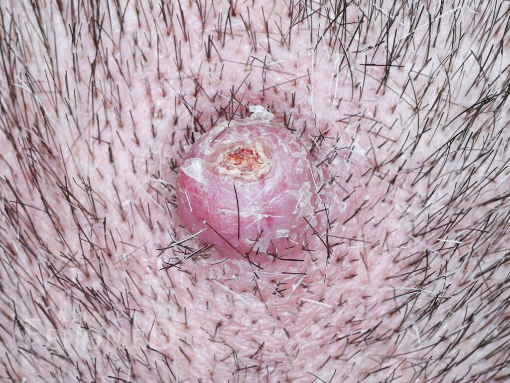 Ziarniniak naczyniowy na skórze głowy