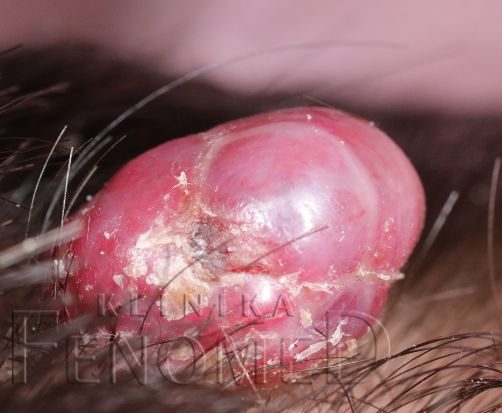 ziarniniak naczyniowy