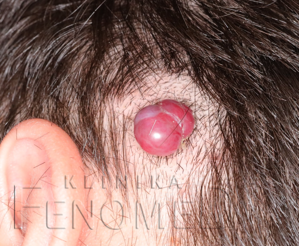 Ziarniniak naczyniowy na głowie.