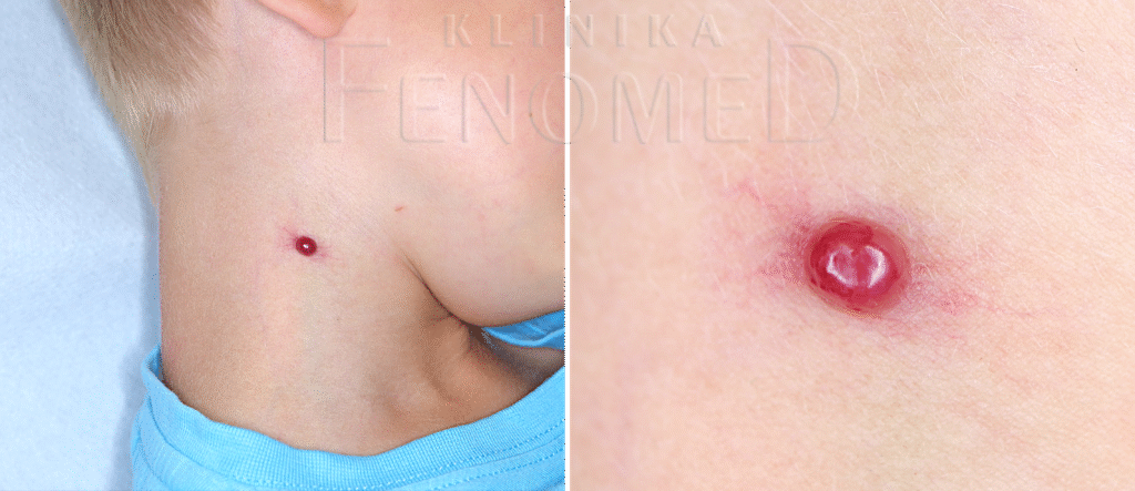 ziarniniak-naczyniowy