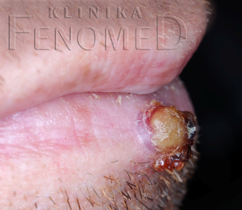 Ziarniniak naczyniowy na wardze dolnej.