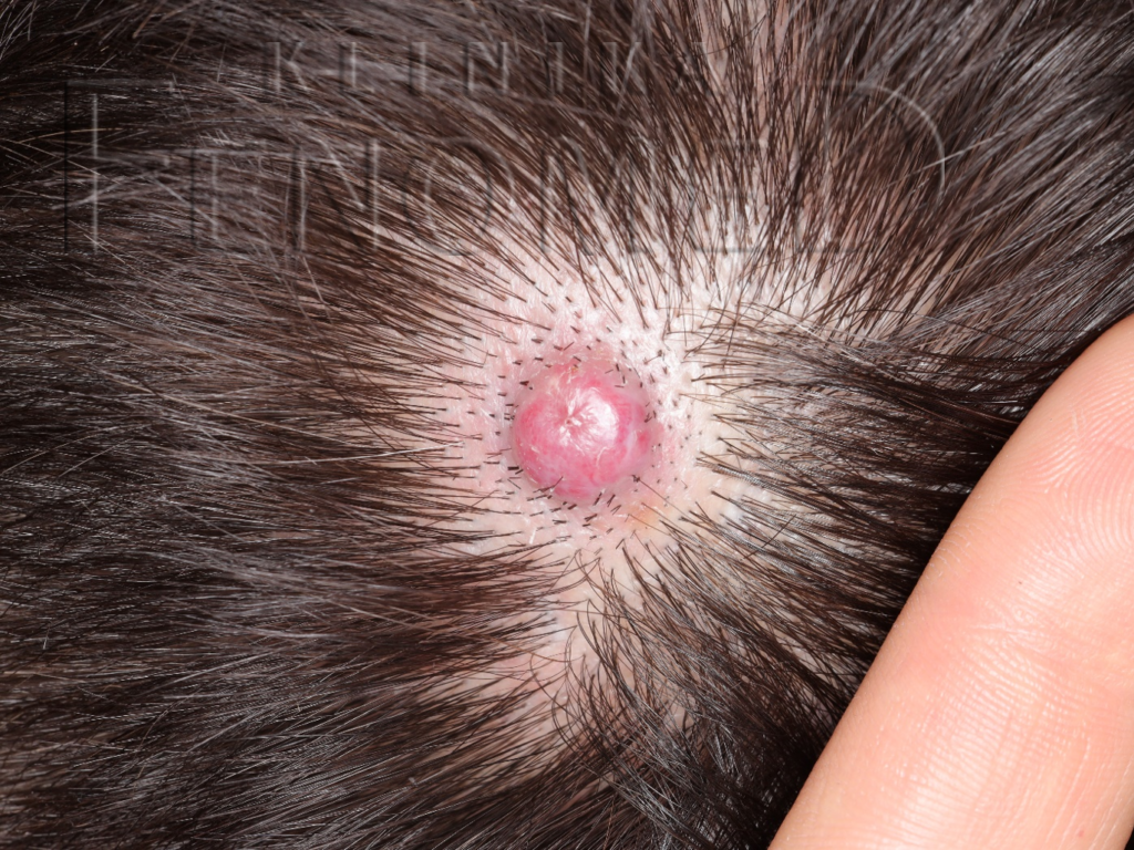 Ziarniniak naczyniowy na skórze głowy