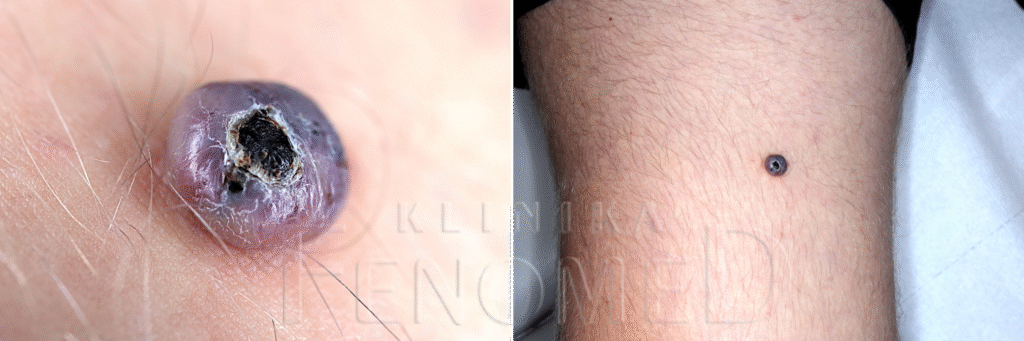 Ziarniniak naczyniowy na skórze uda.