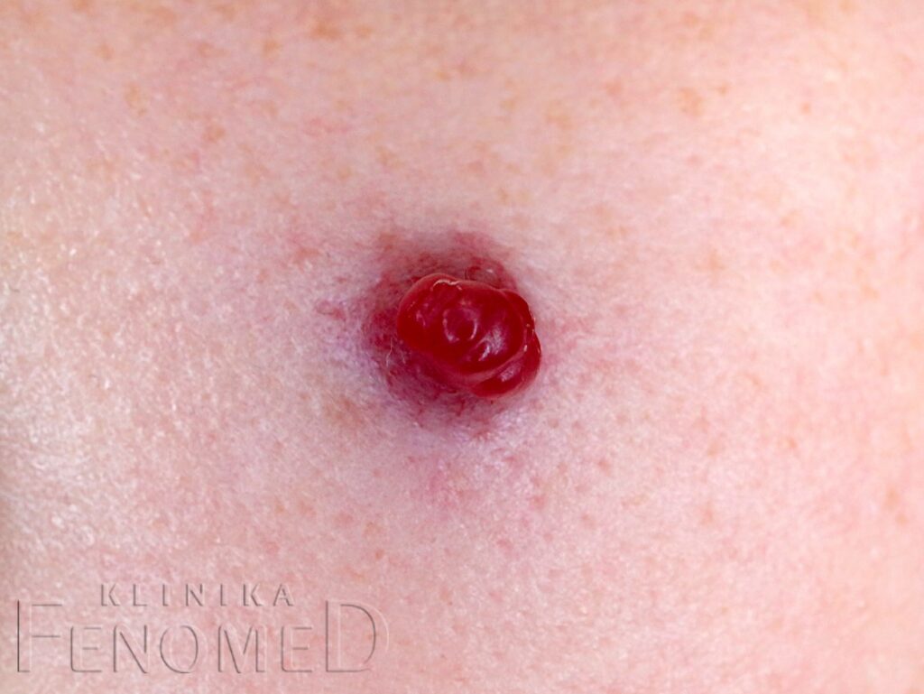 Ziarniniak naczyniowy na policzku