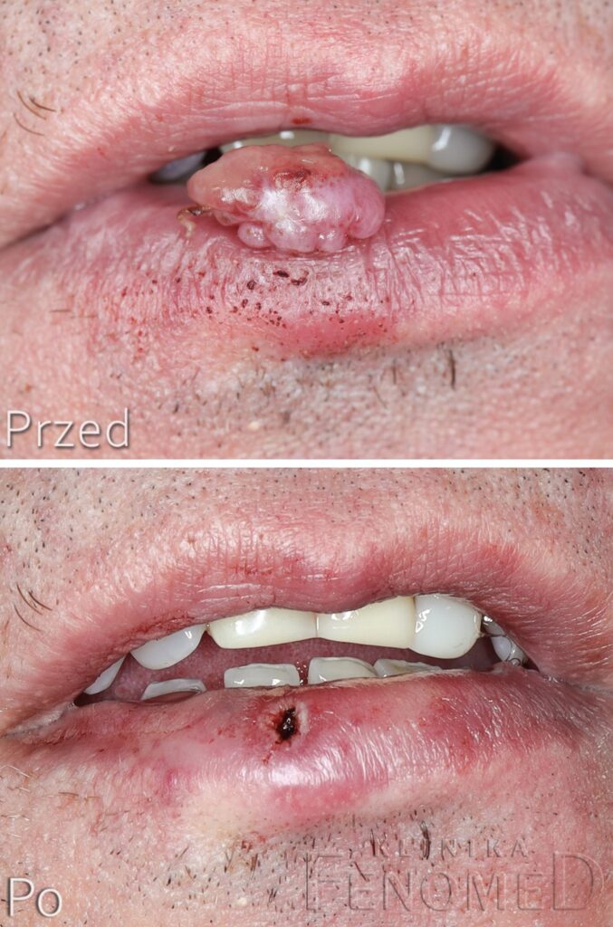 Ziarniniak naczyniowy na wardze górnej. Stan przed i bezpośrednio po zabiegu.