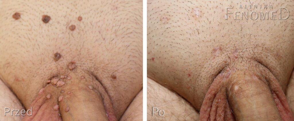 kłykciny kończyste - stan przed i po leczeniu