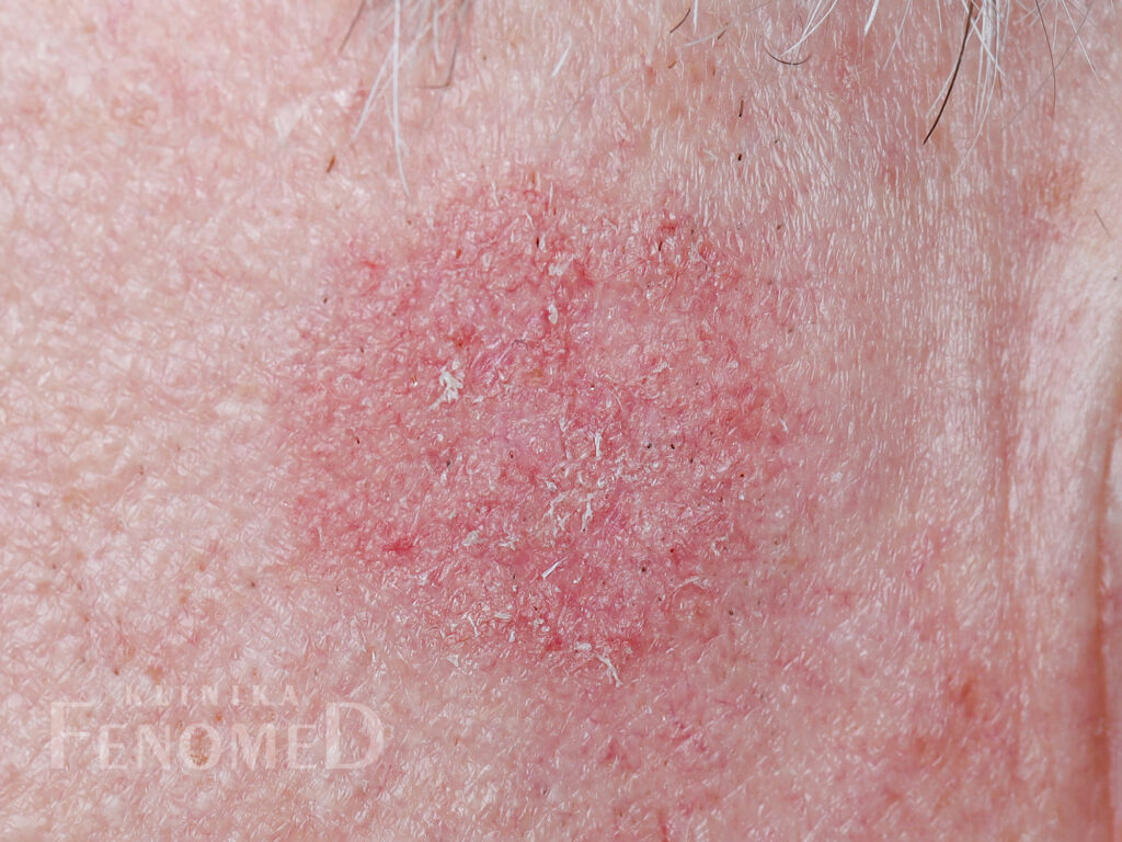 Rogowacenie słoneczne