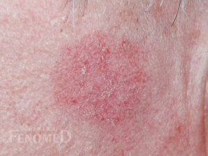 Rogowacenie słoneczne