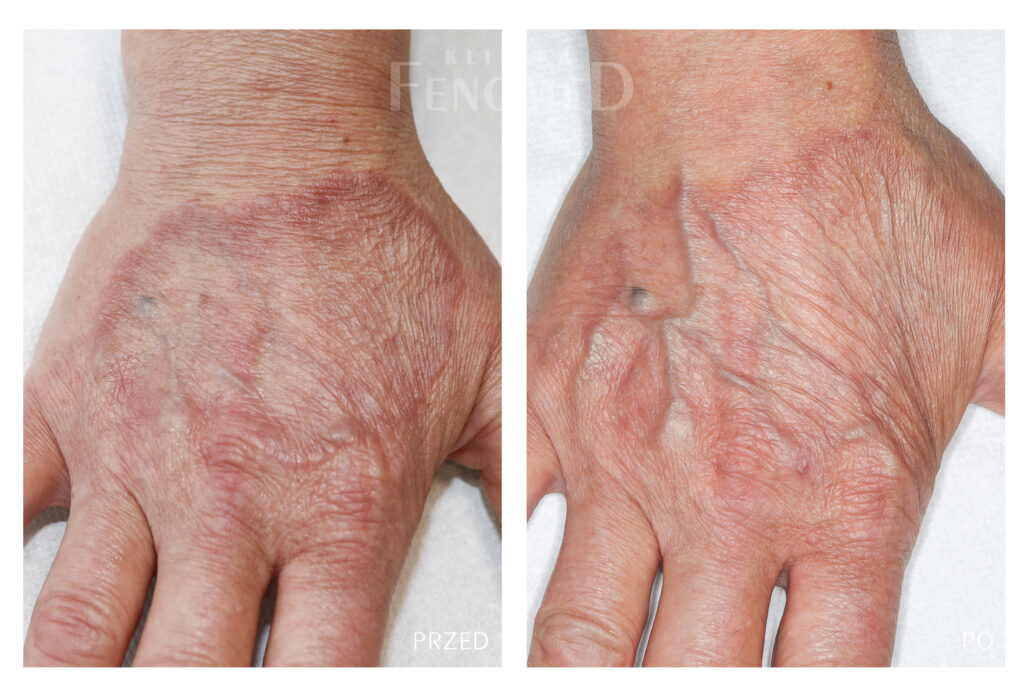 ziarniniak obrączkowaty