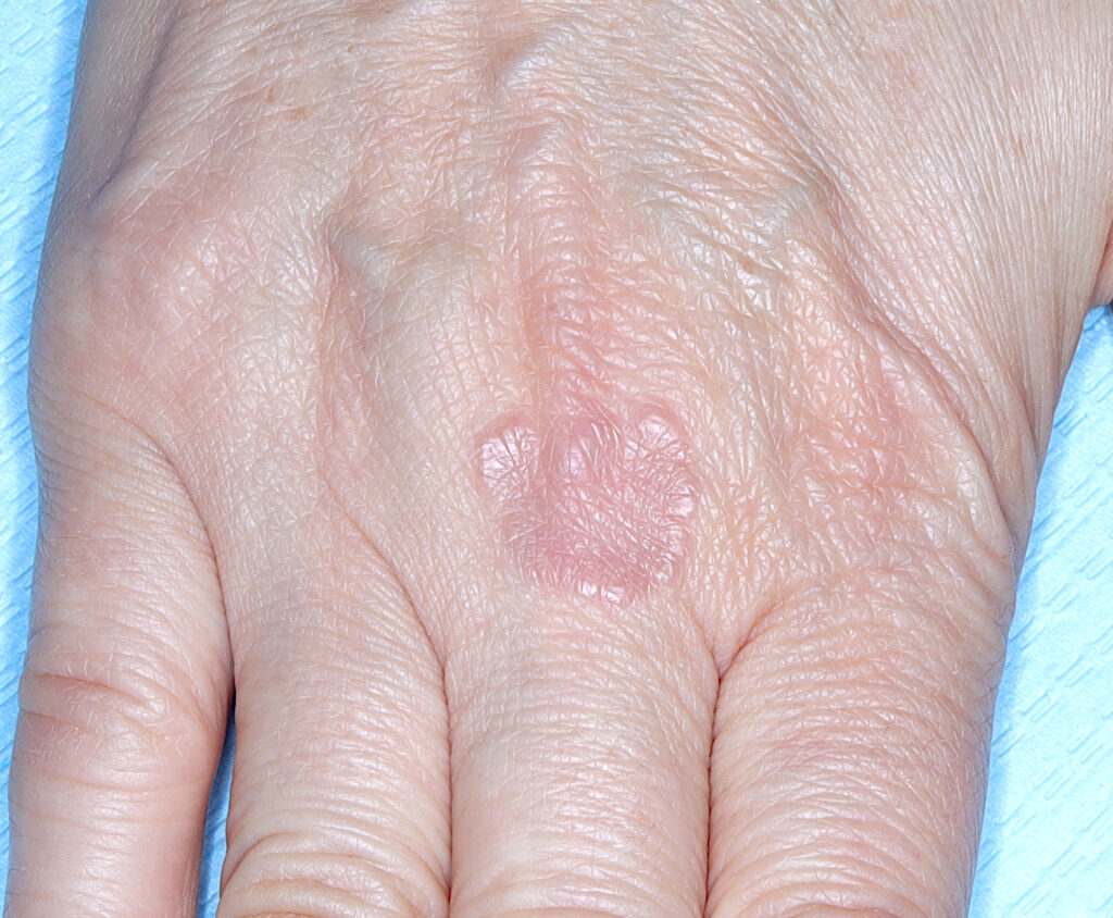 Ziarniniak obrączkowaty