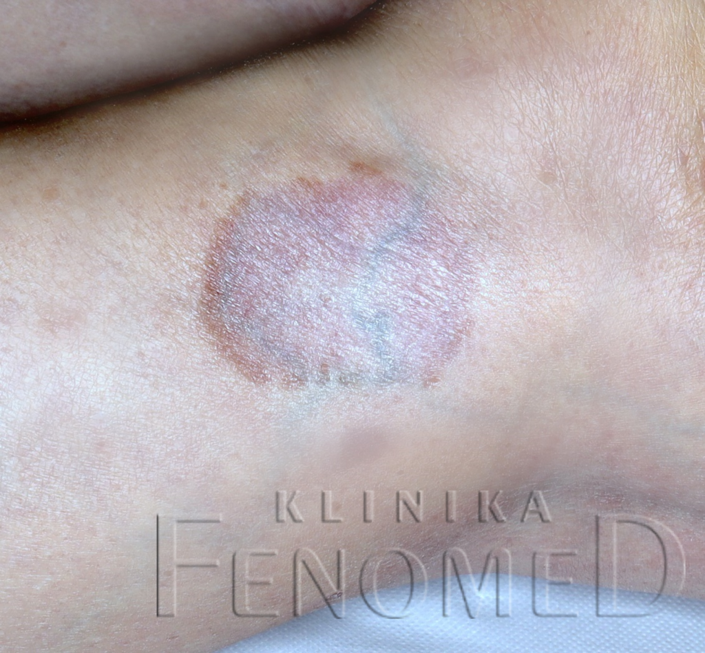 ziarniniak obrączkowaty