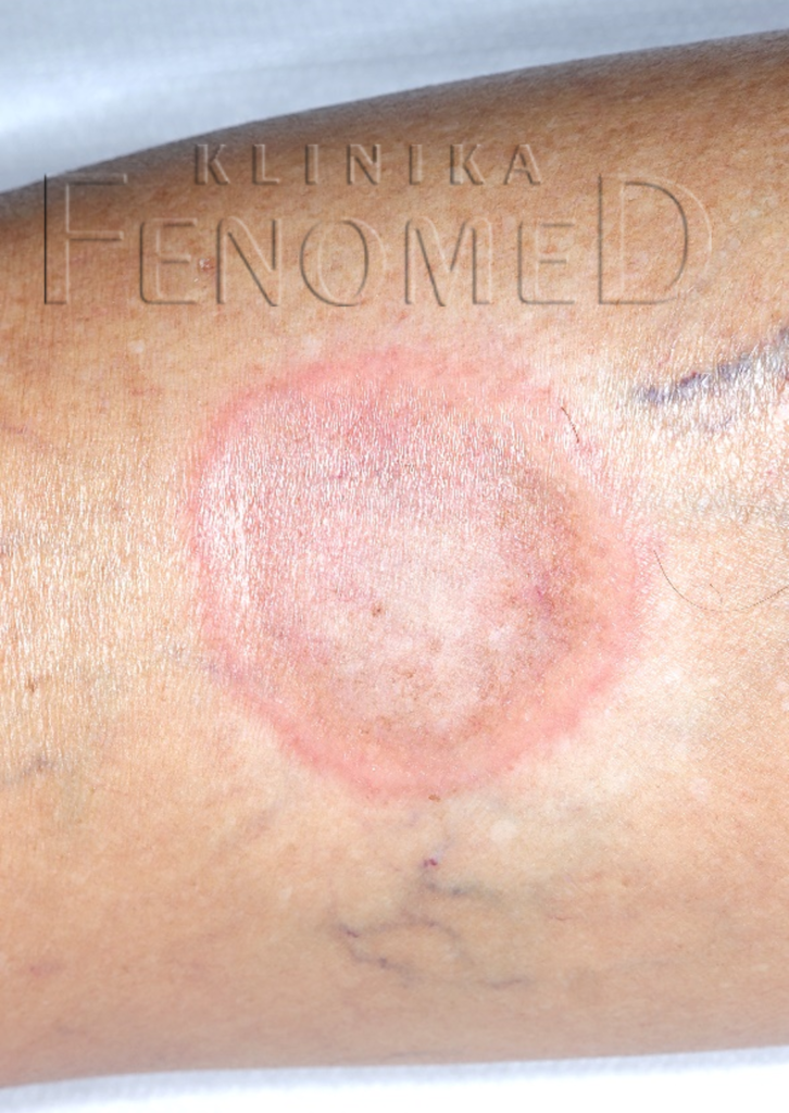 Ziarniniak obrączkowaty