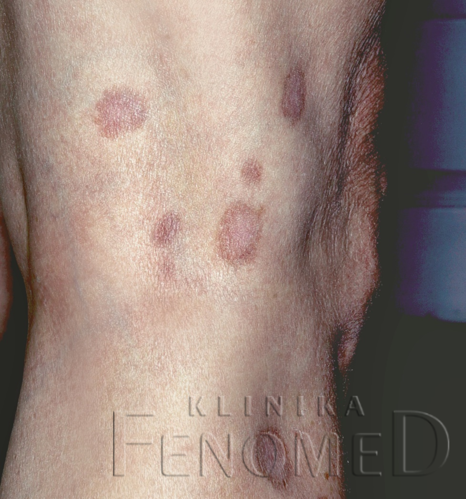 ziarniniak obrączkowaty