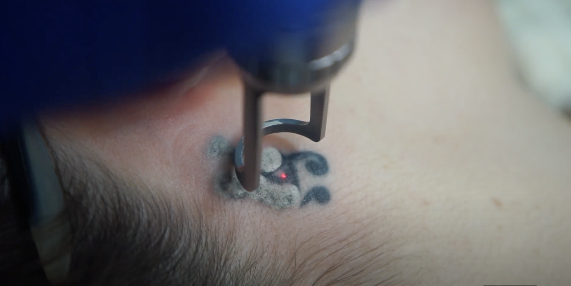 usuwanie tatuażu ile zabiegów